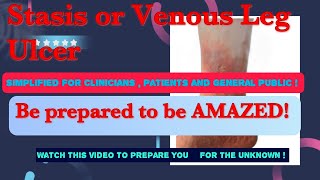 Venous Leg Ulcer Stasis Ulcer  Understanding the cause  treatment and selfmanagement [upl. by Egiarc]