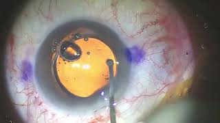 Piggyback ICL for Refractive Surprise Post Phaco Surgery [upl. by Barnebas47]