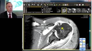 MRI Case Review Shoulder Deep Dive [upl. by Akira]