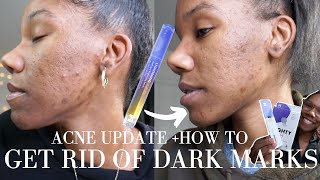 How to get rid of dark marks  acne scars  Acne Update ft Hero Cosmetics [upl. by Rratsal]