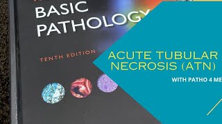 acute tubular necrosis ATN  kidney amp tubulointerstial pathology  SRMBBS 👨‍⚕️😉 [upl. by Asilrahc41]