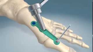 1st metatarsalphalangel joint fusion procedure [upl. by Rona]