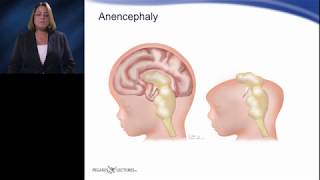 Quick Concepts  Acrania vs Anencephaly [upl. by Ainesej]