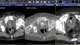 How to read a CT Cystogram [upl. by Mihsah892]