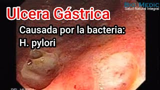 Ulcera gástrica causada por H pylori [upl. by Trebma]