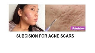 Acne scar treatment Subcision and TCA cross [upl. by Jordans433]