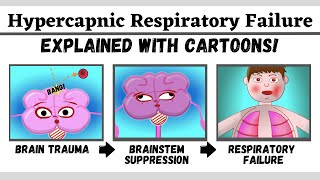 Hypercapnic type 2 respiratory failure explained with cartoons [upl. by Alaunnoif]