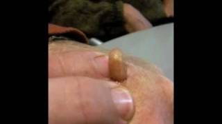 Man Squeezes Botfly from Hand [upl. by Naoma]