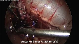 Laparoscopic Pyeloplasty in an Infant [upl. by Dorfman694]