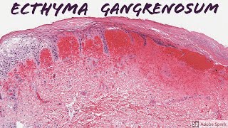 Ecthyma Gangrenosum 5Minute Pathology Pearls [upl. by Yager]