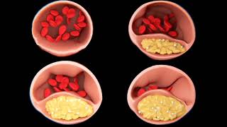 HIPERCOLESTEROLEMIA CAUSAS SÍNTOMAS Y TRATAMIENTO [upl. by Dusen320]