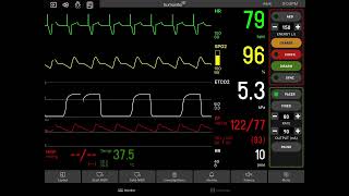 Cardiac Pacing [upl. by Yelrak]