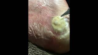 Plantar Wart With DuckTape [upl. by Treulich]