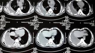 Split Pleura Sign on CT Scan  Radiology Signs  Empyema Lung [upl. by Mines]