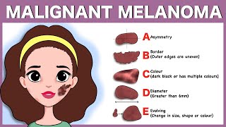 Malignant melanoma Signs Pathophysiology Types Diagnosis Treatment [upl. by Sitnik]