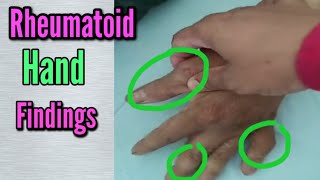 Rheumatoid Hand  Common Findings  Swan neck deformity Z deformity Boutonniere deformity [upl. by Gnirol]