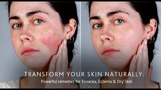 Proven Rosacea Treatments for Clearer Skin [upl. by Annawt3]