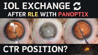 Patient NEEDS HELP after RLE with Panoptix  IOL Exchange [upl. by Annadiana592]