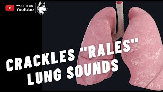 Abnormal Lung Sounds  Fine crackles Coarse crackles Rales  Lung sounds [upl. by Lohse]