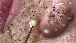 Blackhead Removal With Sac Dep Spa 1000312 [upl. by Cohe201]