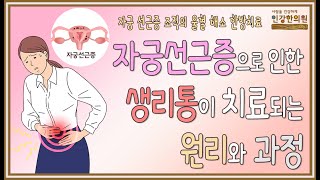 한방 치료로 자궁선근증이 줄어들고 소실되면서 빠른 속도로 생리통이 사라질 수 있어요 [upl. by Claus]