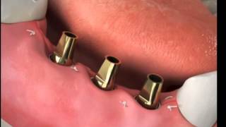 Implant Bridge Procedure [upl. by Yauq]