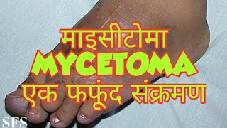 Mycetoma in hindi [upl. by Abbottson429]