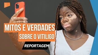 Descubra os mitos e verdades sobre o vitiligo‌ [upl. by Trinee]