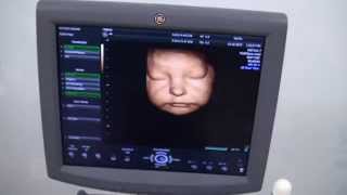 GE VOLUSON P8 3D4D COLOR DOPPLER  INDIAULTRASOUND [upl. by Lauren56]