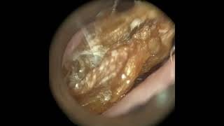 253  Complex Ear Wax amp Dead Skin Extraction from Narrow Ear using the WAXscope®️ [upl. by Noevart141]