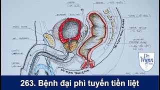 263 Bệnh phì đại tuyến tiền liệt U xơ tiền liệt tuyến [upl. by Refenej]