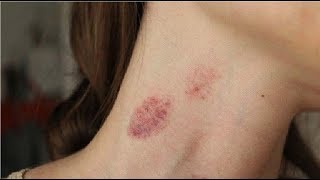 how to properly remove a hickey in minutes  best tutorial to remove a hickey fast [upl. by Purvis]