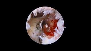 Elbow Arthroscopy  Osteoarthritis  Nicky Leung MD [upl. by Stanway]