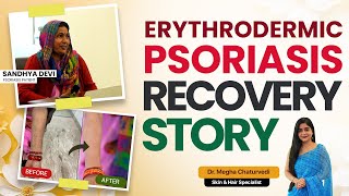 Erythrodermic Psoriasis Recovery Story  Dr Megha Chaturvedi Psoriasis Treatment in India [upl. by Alfie]