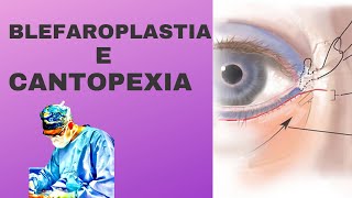 Blefaroplastia e cantopexia [upl. by Grishilda]