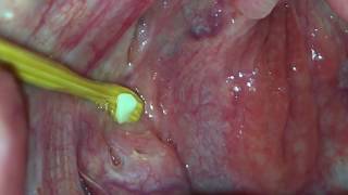 Tonsil Stone Removal Using Wooden Tool [upl. by Halbert]