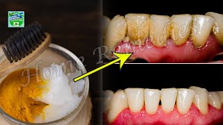 How To Remove Plaque And Tartar From Your Teeth Without A Dentist [upl. by Ayanahs]