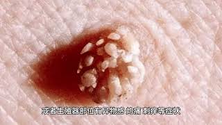 HPV42阳性能自愈吗 [upl. by Ennovy]