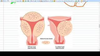 Adenomyosis  Concept  Diagnosis Management [upl. by Allesig]