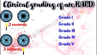 Pupil 4  Clinical grading of an RAPD  Marcus Gunn Pupil [upl. by Akinod]