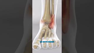 Ankle Fracture Surgery 3D Animation [upl. by Leena]