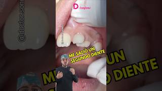 dientes amontonados ortodoncia brackets alineadores protesisdental dentista shorts dientes [upl. by Malonis]