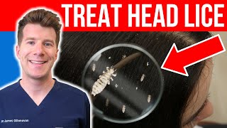 How to TREAT HEAD LICE AND NITS  Doctors stepbystep guide [upl. by Alle]