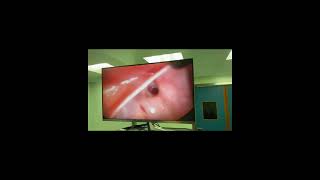 Hernia inguinal por laparoscopia [upl. by Eugenio753]