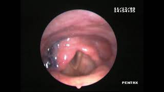 FEESUntersuchung ZenkerDivertikel vs Reflux [upl. by Hazard]