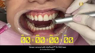 Veneer removal with LiteTouch™ ErYAG laser [upl. by Cornelie122]