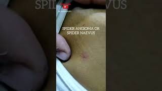 Spider Angioma or Spider Naevus  Chronic Liver Disease [upl. by Christabel]