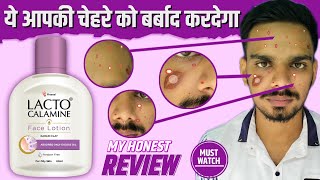 You Must Watch This Video Before Using Lacto Calamine Face Lotion [upl. by Etnaled]