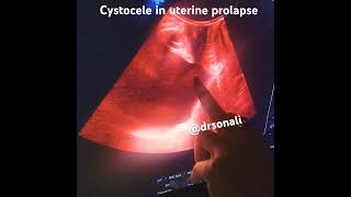 Cystocele demo on tvs in patient of uterine prolapse [upl. by Othe]