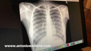 How To Read a Chest Xray in 30 Seconds Or Less [upl. by Hill]